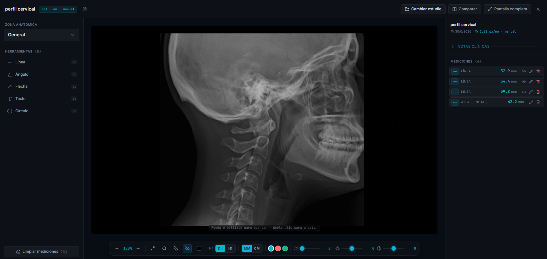 Visualizador clínico de Quironex: radiografía de perfil cervical con mediciones dibujadas sobre la placa y el panel de resultados.